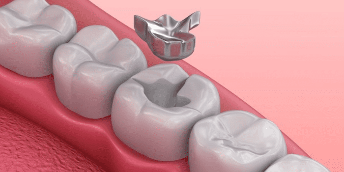 Mercury Amalgam Fillings