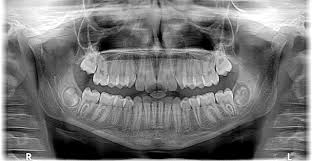 A Closer Look at Your Smile: The iTero® Element 5D Scanner at Kudlik Dental